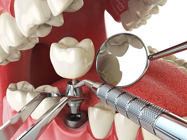 Best Emergency Tooth Extraction in San Rafael, NM